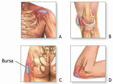 Bursitis