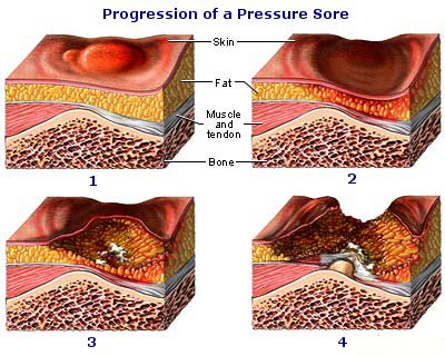 progression-pressure-sore
